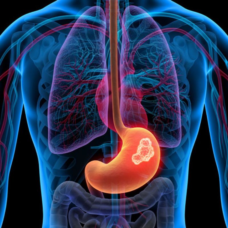 Comuna de Curicó implementó Test no invasivo de aire espirado, para detección de principal bacteria responsable de cáncer gástrico